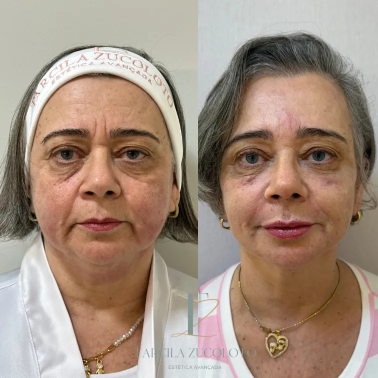 Beige Minimalist Skincare Before and After Instagram Post